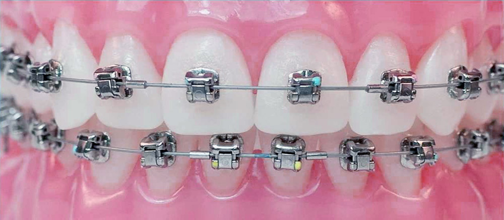 Металлические брекеты Томск Батистовая имплантация зубов цены в томске