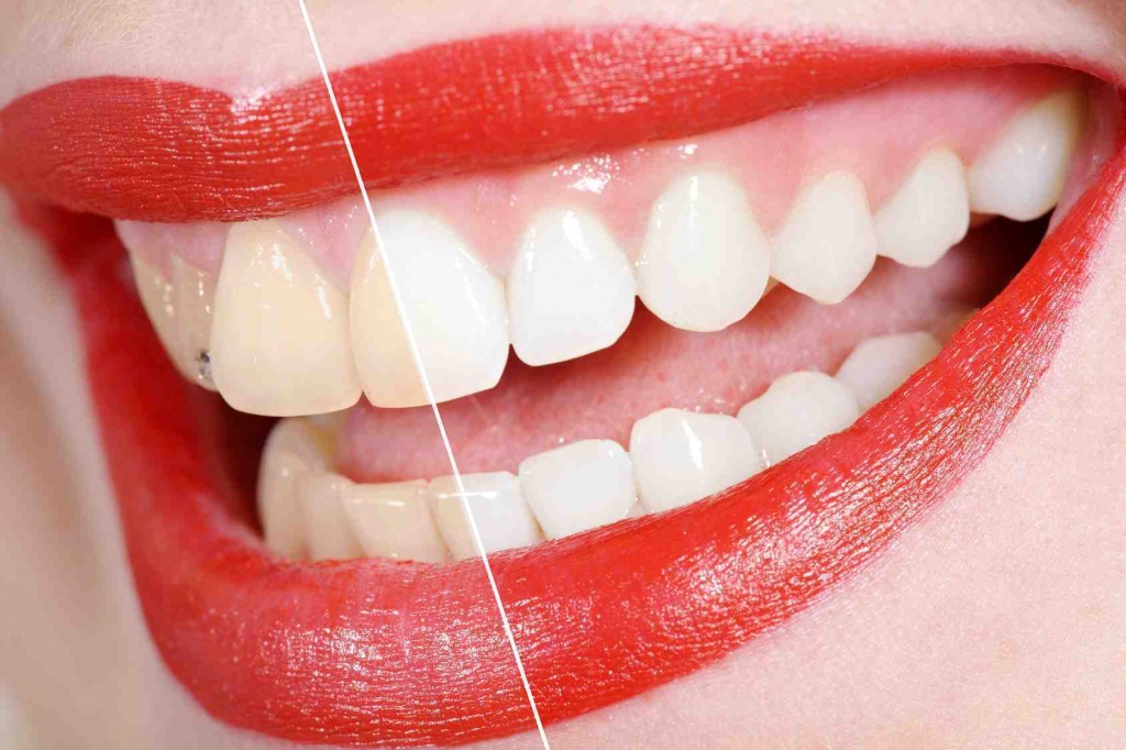 otbelivanie-zubov-2.jpg