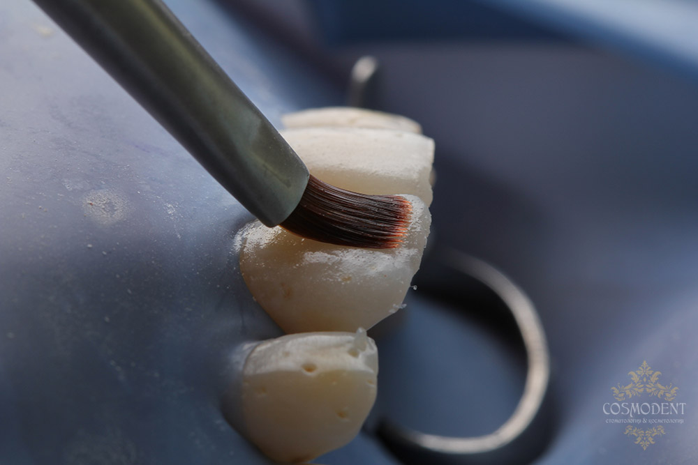Сколько стоит реставрация зубов томск Покрытие зуба защитным лаком Томск Золотистая