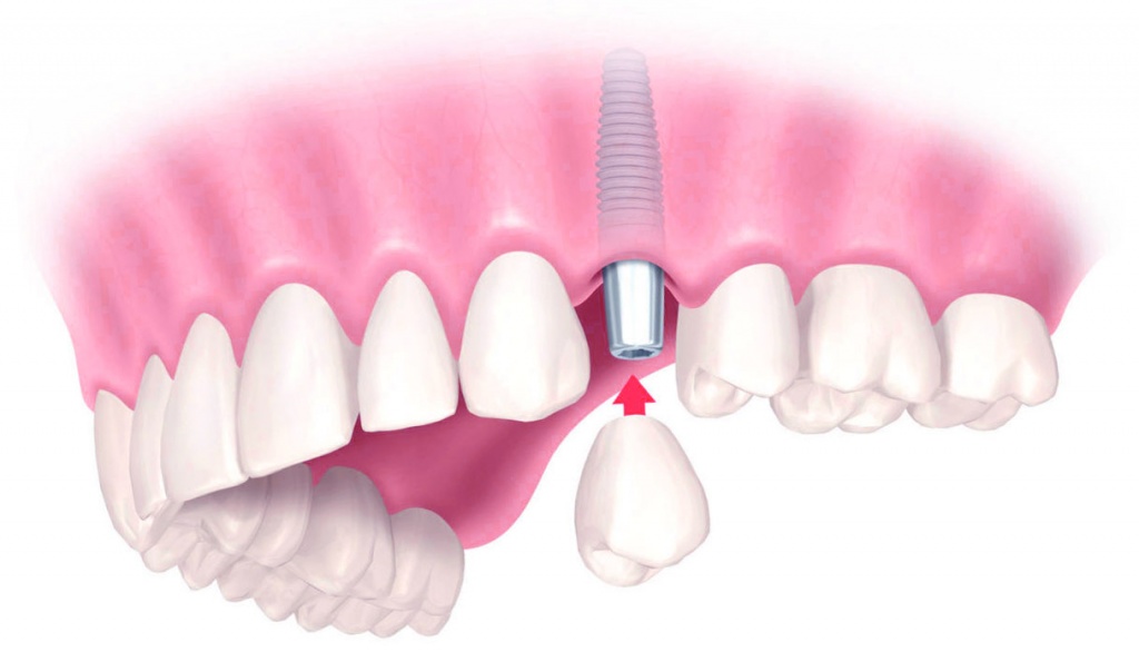 Имплант зуба корея. Зубные протезы съемные. Альтернатива имплантации зубов.