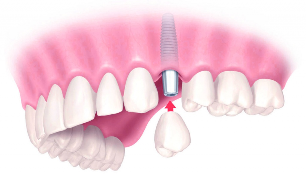 отзывы о имплантации зубов томск