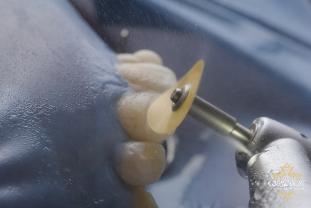 Реставрация молочных зубов Томск Карьерный стоматология в томске на ленина 58