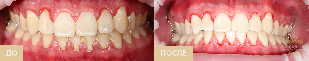 Снятие зубных отложений Томск Яковлева