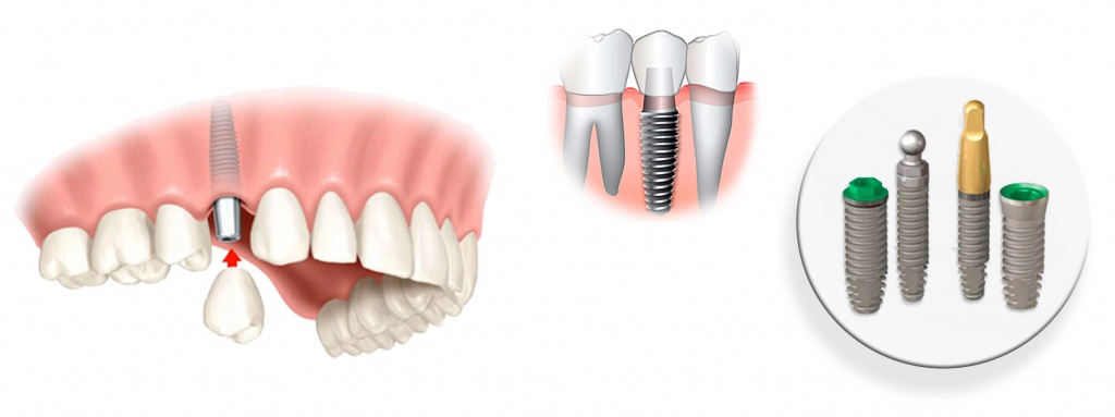 Имплантация зуба томск стоматология в томске отзывы эликсир